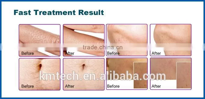 Hot selling high accuary professional 808nm laser hair removal tria home use