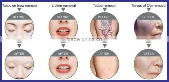 5 in1 multifunctional beauty machine laser nd yag ipl for hair removal and tattoo removal