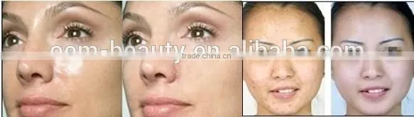 Body care equipment q switch laser tattoo removal equipment