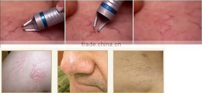 Skin treatment laser red blood vascular spot removal