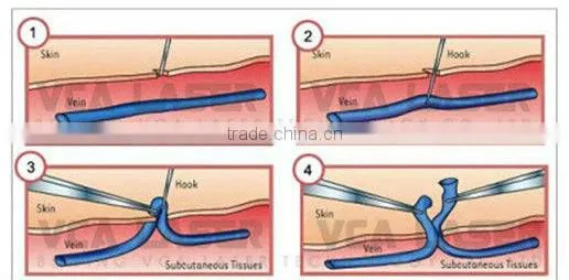 Excellent portable red vascular laser treatment