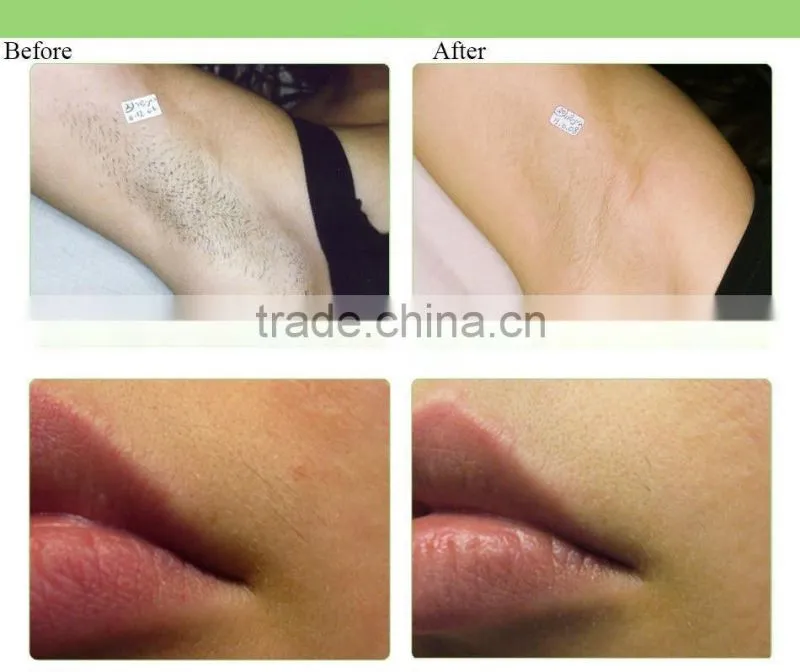 wholesale Laser beauty ipl Hair Removal easily cleaned armpit hair / bikini leg / arm / frontal hairline hair