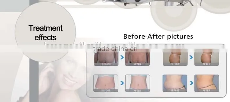Lipolaser slimming machine loss weight and cavitation machine