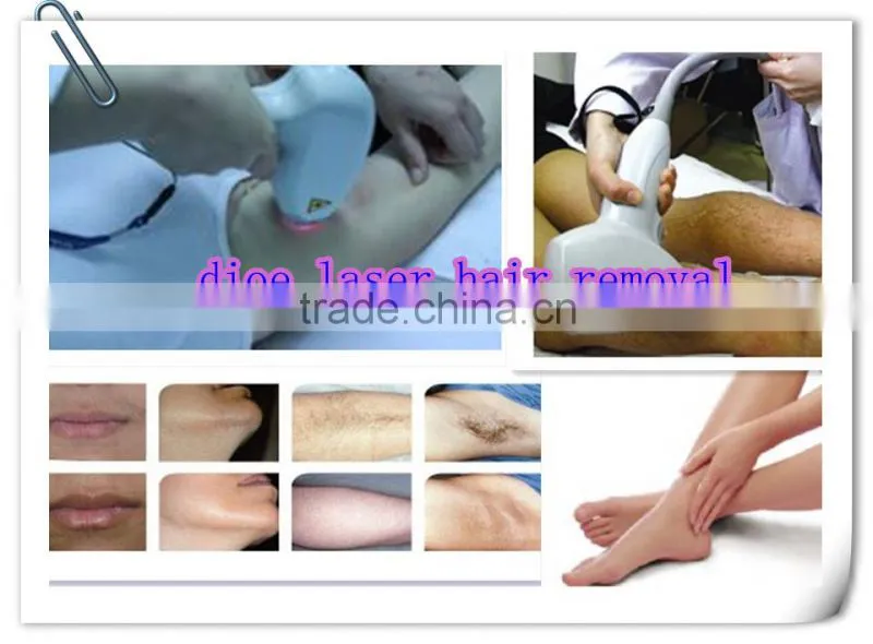 portable diode laser hair removal machine