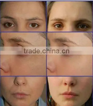 Portable Hair Remover Laser System