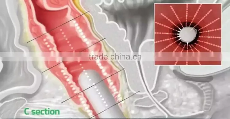 portable women sex hifu vaginal tightening machine with 10000shots
