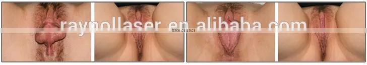 Ultrasonic System HIFU Vaginal Machine China Supplier