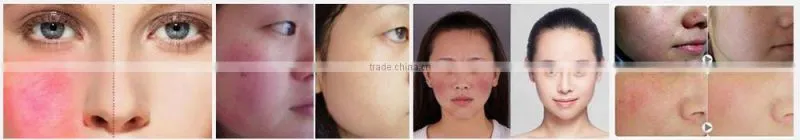 high frequency spider vein/vascular/blood vessels removal machine