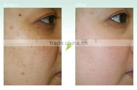 hot selling ipl age spots pigmentation hair removal machine ipl flash lamp rf nd yag laser machine for hair removal