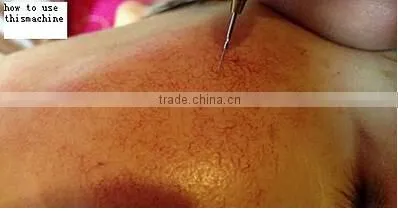 2017 Hot seller Professional Ultrapulse Laser Vein Removal Machine/Vascular Spider Veins Removal