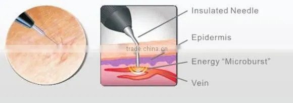 Magic Effect !! thread vein vascular removal spider vein laser