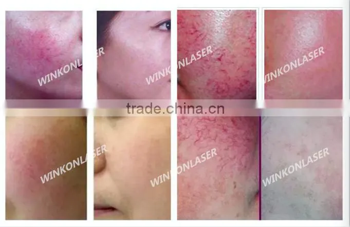 varicose veins / blood vessel spider vein treatment / spider vein spot removal machine