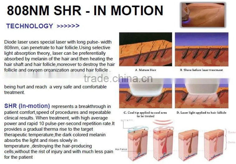 Germany Bars professional laser hair removal machine