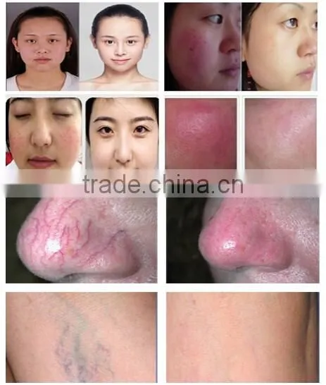 Good price blood vessels removal 980nm diode laser spider vein removal machine