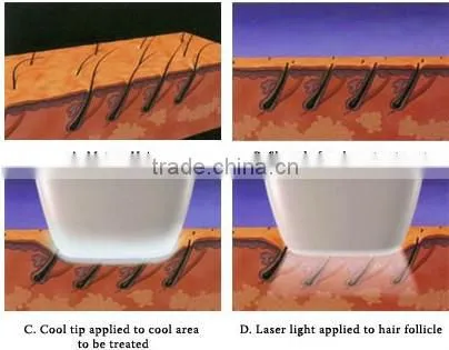 ipl laser machine radiator