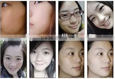 latest product 2016 led light therapy beauty machine and acne removal beauty product