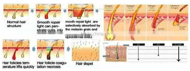 CE approved high quality today tomorrow forever!most effective ipl hair removal ipl elight shr