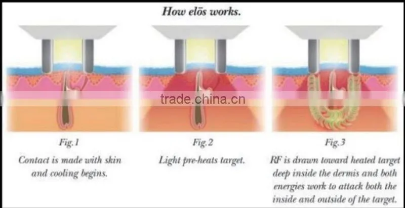 New Arrival Real manufacturer supply vertical e-light ipl rf for depilation