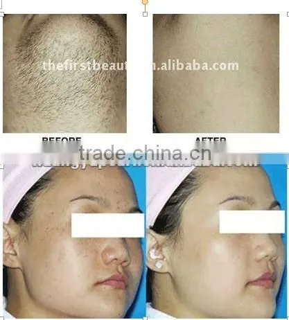 Protable soprano laser hair removal machine P003