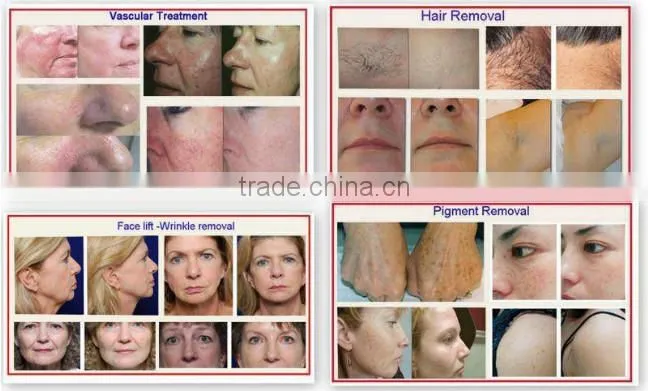 Portable ipl laser hair removal machine