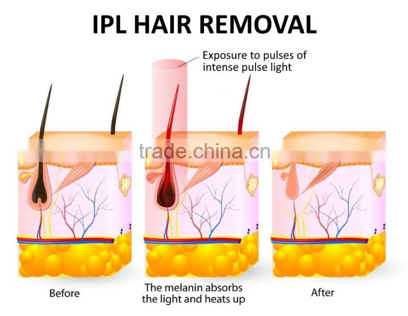 2017 new Professional System electric lumea ipl lady laser hair removal epilator machine