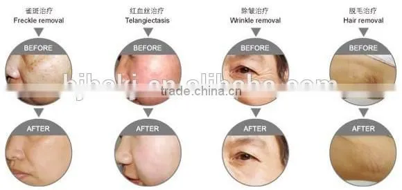 Hot selling !! ipl skin rejuvenation/portable ipl skin care