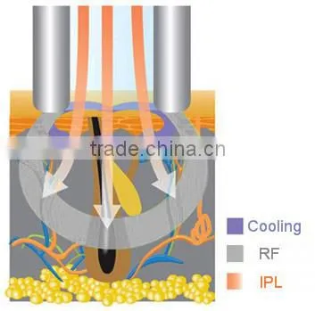 zhejiang yiwu ipl e-light beauty machine Manufacturer