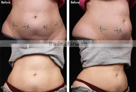 2016 Freezing Fat Cell Slimming Loss Weight Cryolipolysis Machines