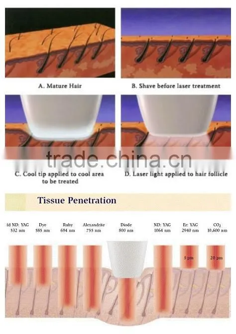 hair removal laser machines / laser hair removal eyebrows / laser hair removal turkey