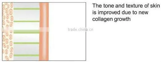 At home skin tightening machine(HM-RF-A100)