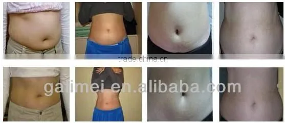 5 in 1 wrinkle removal machine/ultrasonic vacuum multipoalr rf cavitation fatness loss machine