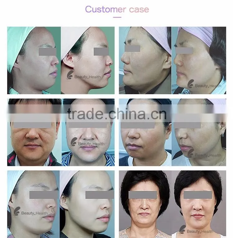 Beauty salon high intensity focused ultrasound hifu beauty machine