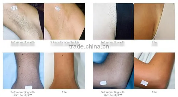 T&B distributor 2000W 808nm diode laser epilation machine