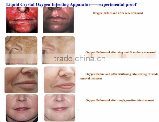 Oxygen Peel machine