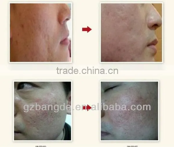 Handheld electric microneedle in derma rolling system BD-WZ001