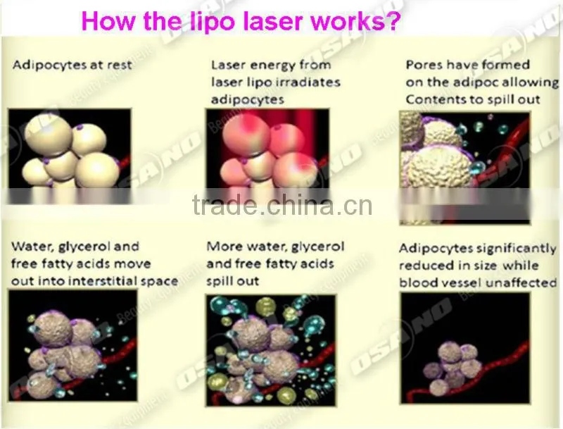 Osano body sculpting 650nm lipo laser machines