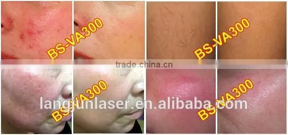 Spider Vein Removal/Vascular Removal