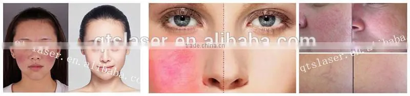 2015 New 30MHZ high frequency Facial Vascular Removal Device