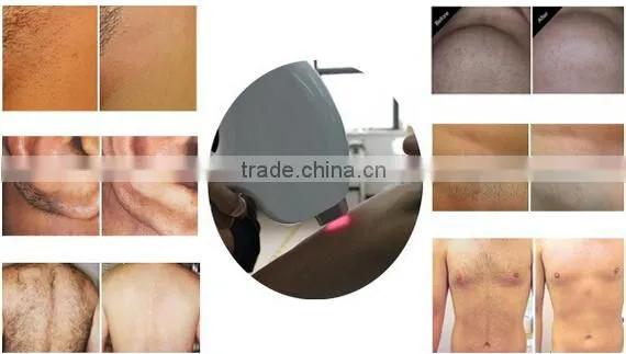 Over 20 million flashes Best Seller professional cooling system home diode hair laser hair removal device