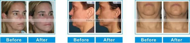 Professional hifu machine ultrasound machine in germany for face lift and wrinkle removal