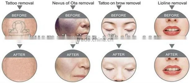 multifunction beauty machine with elight ipl rf nd yag laser