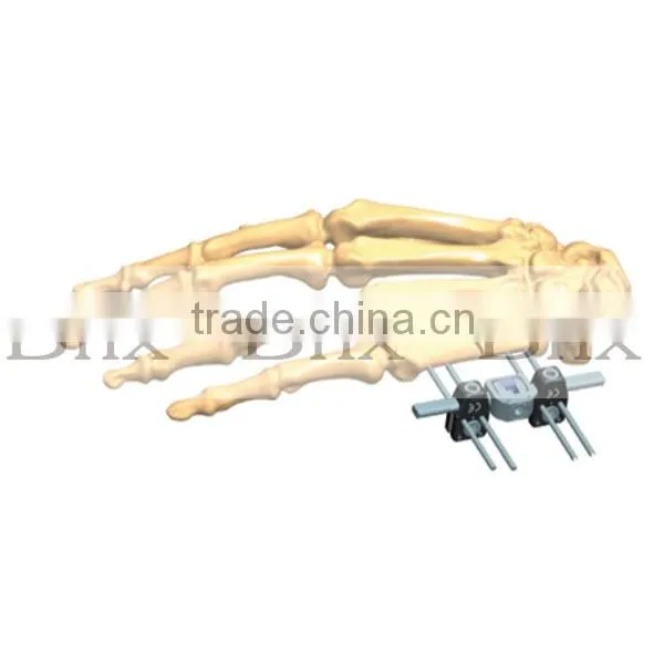 Surgical Deformity Corrcetion External fixator