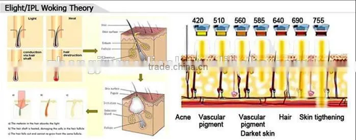 2014-Newest Portable laser tattoo removal machine,Nd-yag skin whitening machine