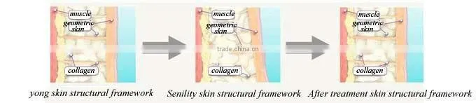Radio Frequency Fractional rf machine skin tightings machine Best Beauty Salon Machine