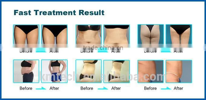 2016 elight ipl rf nd yag laser tattoo removal/skin rejuvenation machine