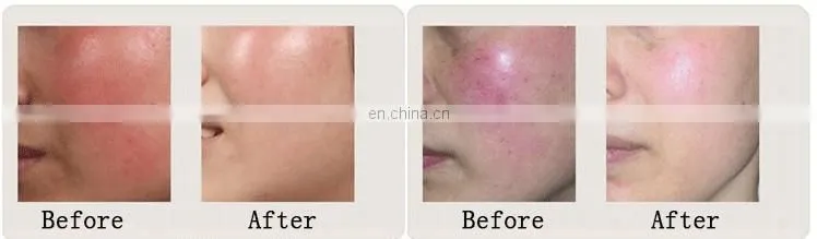 980nm diode vascular machine/vein removal laser/vascular removal laser spider vein removal machine
