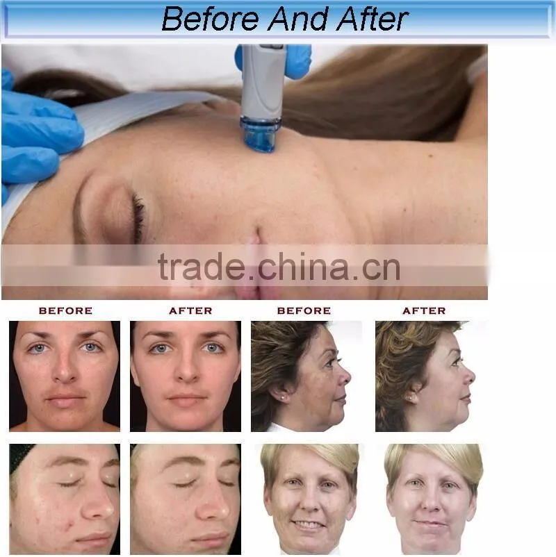 factory direct sale blackhead suction dermabrasion equipment/microdermabrasion machine