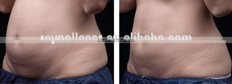 Ultrashape HIFU Body Slimming Cosmetic Hifu Slimming Device