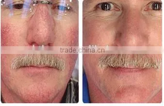 NEW 2016!!! 980nm laser Spider veins removal machine for red blood silk removal,angeioma removal