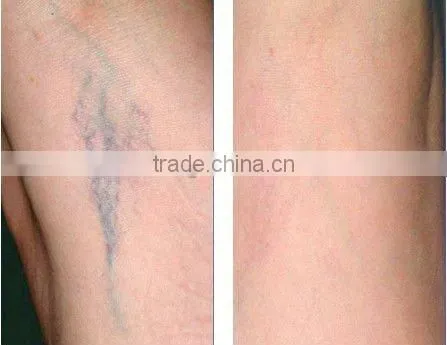 Long pulse ND yag epilation laser permanent laser hair removal/tatoo removal machine for beauty salon
